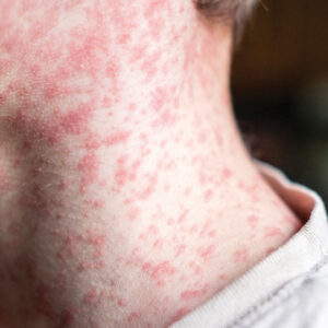 The Re-Emergence of Measles