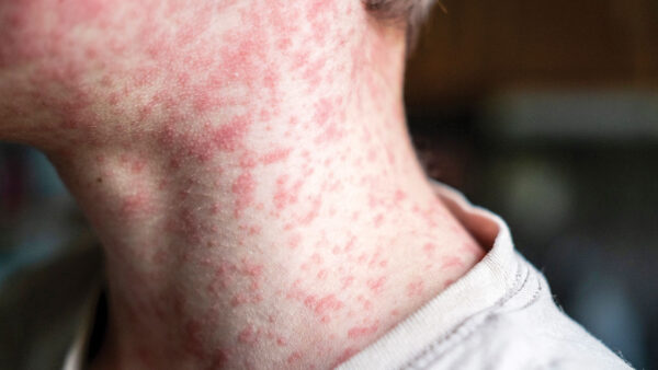 The Re-Emergence of Measles