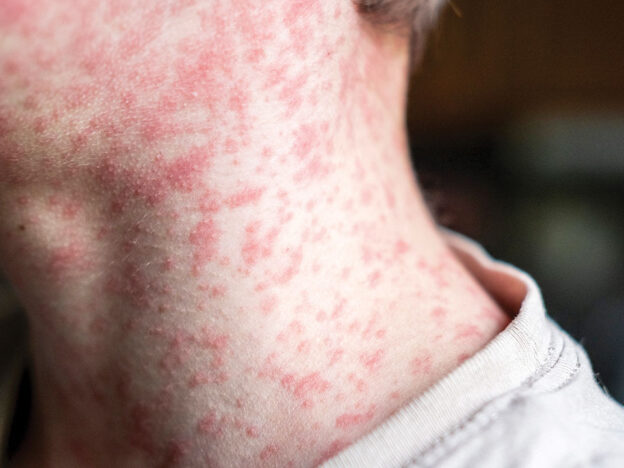 The Re-Emergence of Measles course image