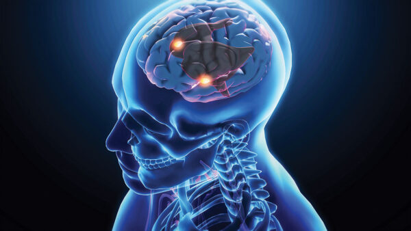 Recognizing and Responding to Young-Onset Dementia