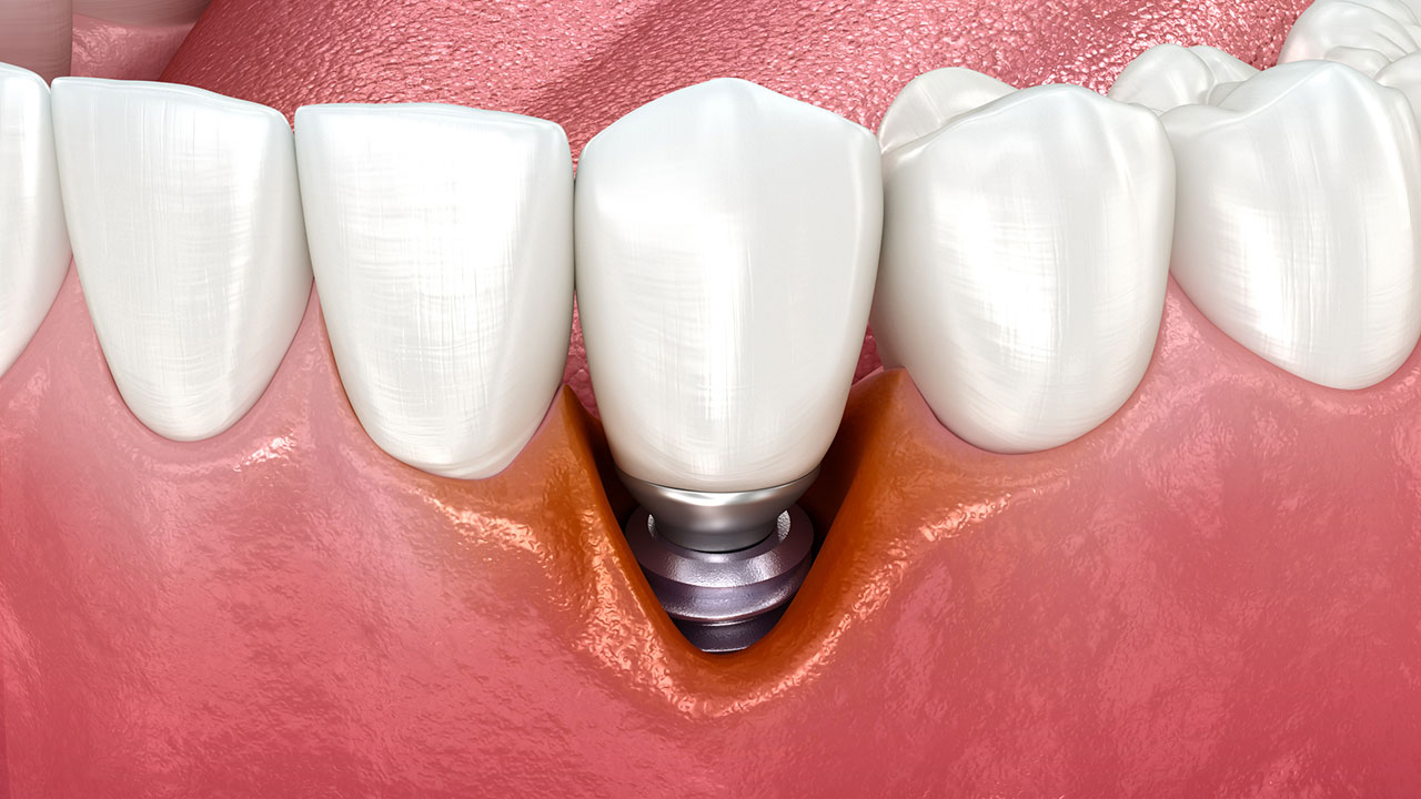 Peri Path New Consensus Charts Clear Path for Managing Peri-Implant Diseases ...
