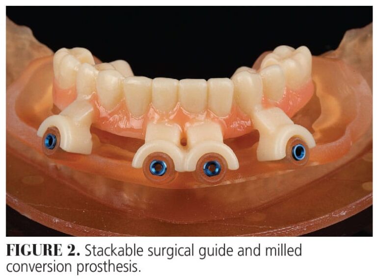 Zirconia and Digital Planning Transform Full-Arch Implant Prostheses ...