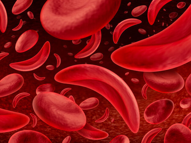 Sickle Cell Disease in the Dental Chair course image