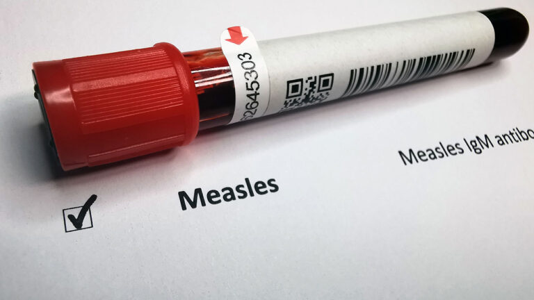 Measles Is Back: The Preventable Disease Threatening Modern Practice ...