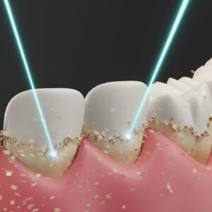Role of Lasers in Modern Periodontal Therapy