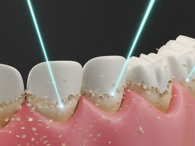 Role of Lasers in Modern Periodontal Therapy course image