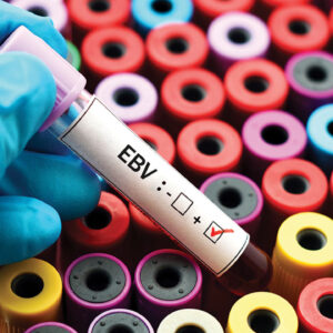 How the Epstein-Barr Virus Impacts Periodontal Health