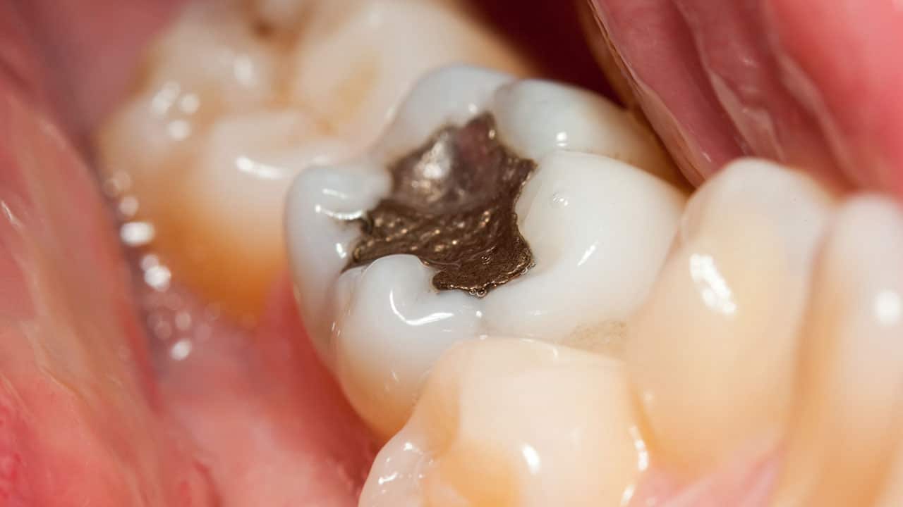 Trump Administration Pushes States Toward Mercury-Free Dentistry