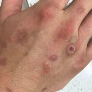 When a Rash Signals Something More