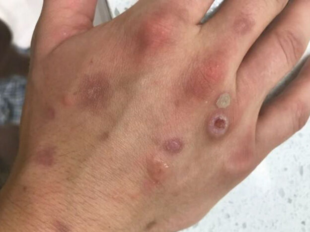 When a Rash Signals Something More course image