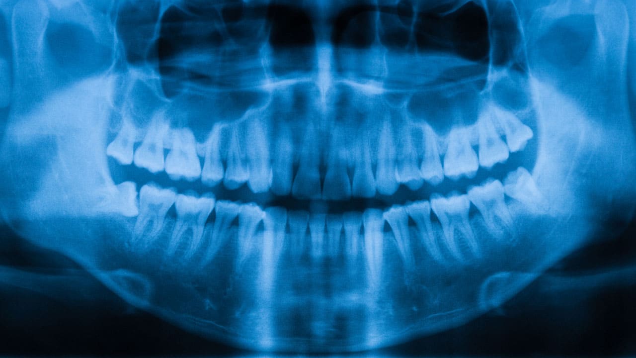When a Tooth Extraction Becomes a Jaw-Threatening Risk By Kristen Pratt Machado On Sep 11, 2026 0