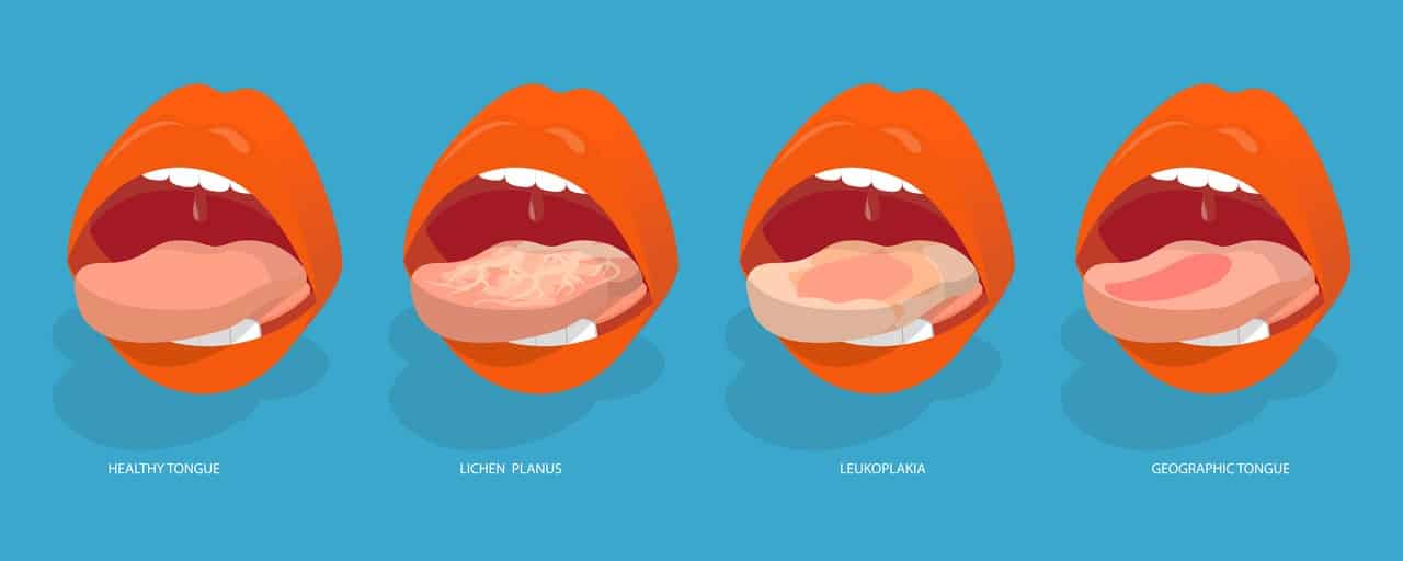 Illustration comparing a healthy tongue, lichen planus, leukoplakia, and geographic tongue