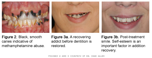 methamphetamine effects on teeth