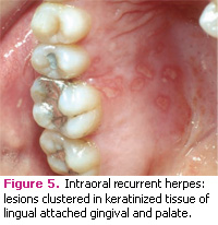 herpetic gingivostomatitis palate