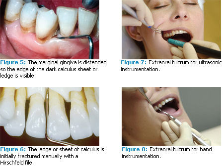 Ultrasonics Unveiled - Dimensions of Dental Hygiene