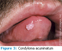 hpv impfung jungen ikk sudwest detoxifierea organismului cu hrisca