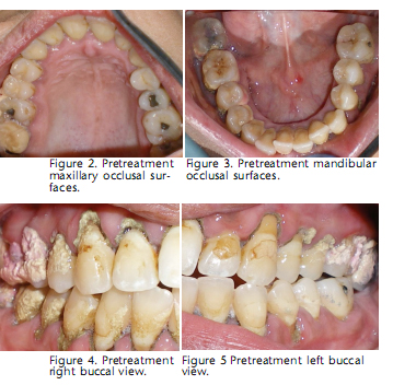 methamphetamine effects on teeth