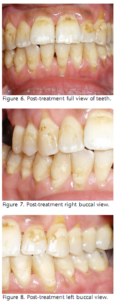 methamphetamine effects on teeth