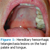 Telangiectasias with tight skin