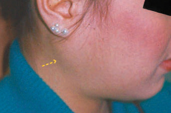 Figure 1. Enlarged parotid gland due to vomiting.