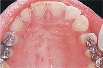 Figure 2. Classic maxillary erosion in patient with bulimia nervosa.