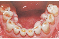 Figure 3. Exposed dentin in patient with bulimia nervosa.