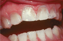 Figure 5. Chipped anterior teeth in patient with bulimia nervosa.