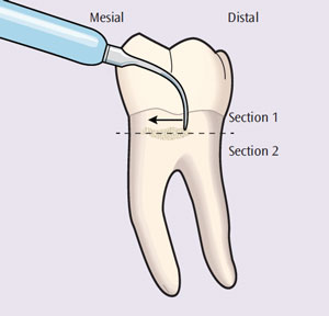 Incorporate Channeling Into Instrumentation - Dimensions of Dental Hygiene