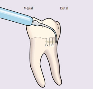 Incorporate Channeling Into Instrumentation - Dimensions of Dental Hygiene