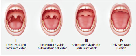 Dental Solutions for Obstructive Sleep Apnea - Hibiscus Dental