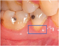 Dentinal Hypersensitivity