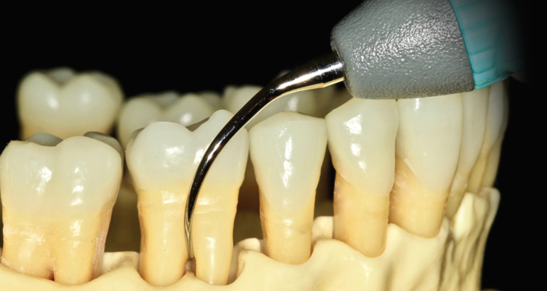 Troubleshooting Instrumentation of Furcations, Concavities & Depressions