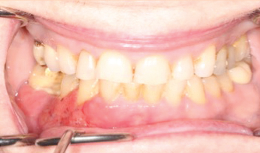 Detecting Gingival Cancer - Dimensions of Dental Hygiene