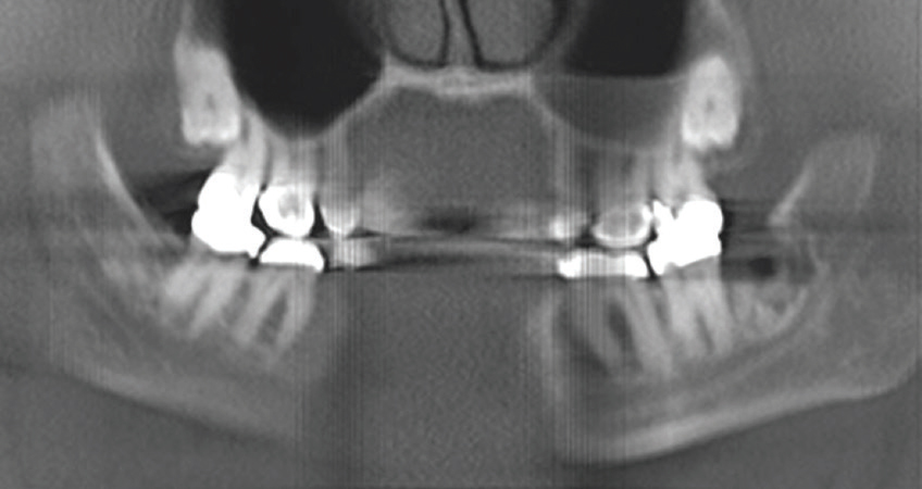 Third Molar Removal - Dimensions of Dental Hygiene